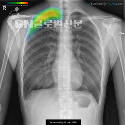 Lunit INSIGHT CXR 2로 검출한 기흉 케이스. 병원에서 사용하는 판독 시스템(PACS)에 탑재되어 판독 환경에 최적화됐다