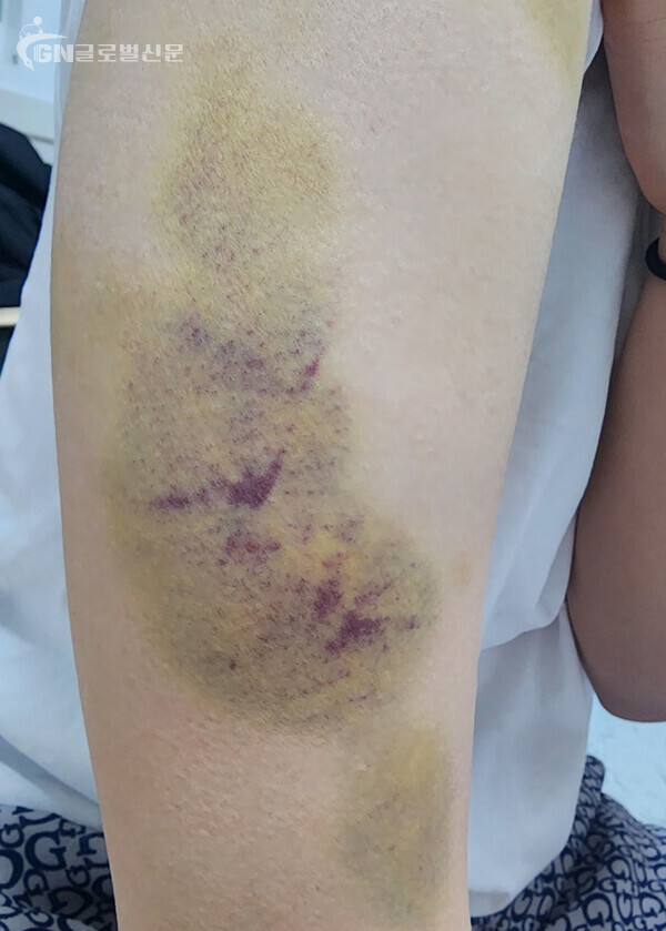  사진 - 피해 학생이 얼굴 폭행을 필사적으로 막기 위해 들어올린 팔에 남은 당시 폭행의 흔적 [JTBC 제공]